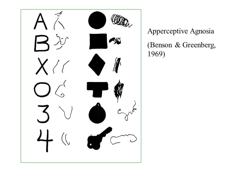 Görsel agnozi'nin insanlar tarafından nasıl göründüğüne dair bir tasvir.